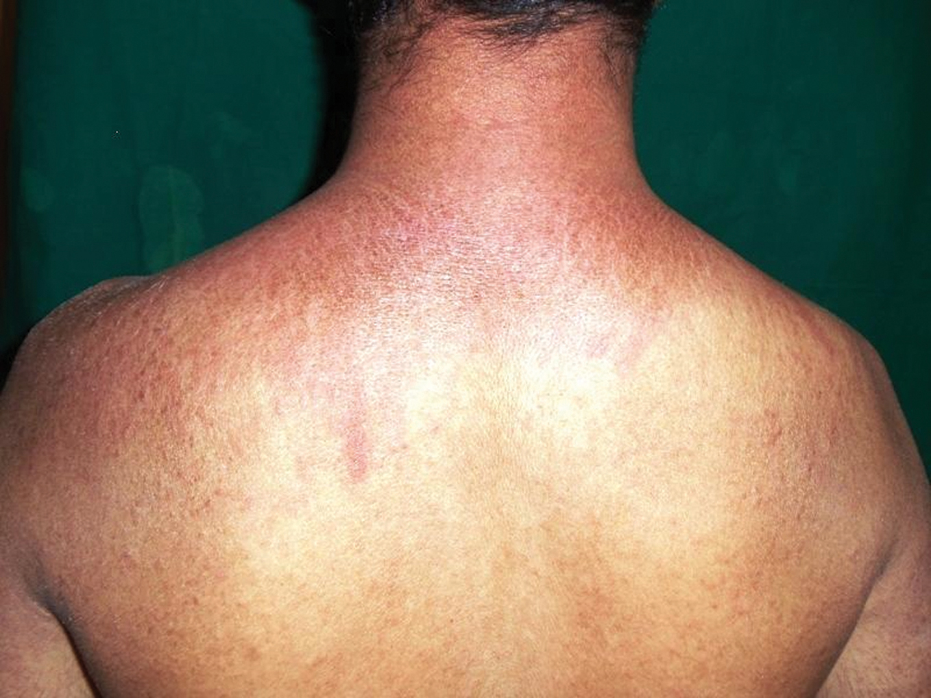 2013.25.Cutaneous Our Dermatology Online